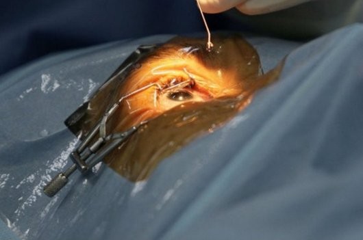 El primer trasplante de retina fabricado con piel detiene la progresión de una degeneración macular