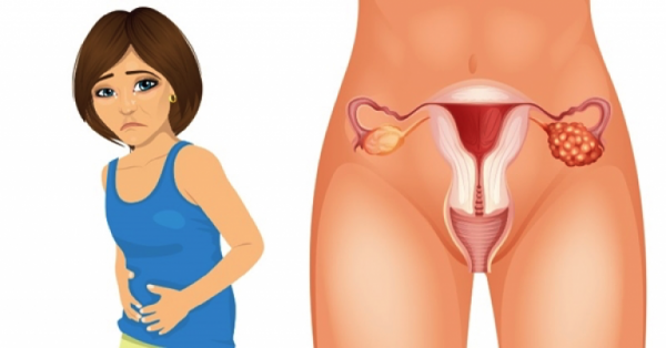 síntomas de cáncer de ovario