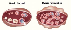 remedio para ovario poliquístico